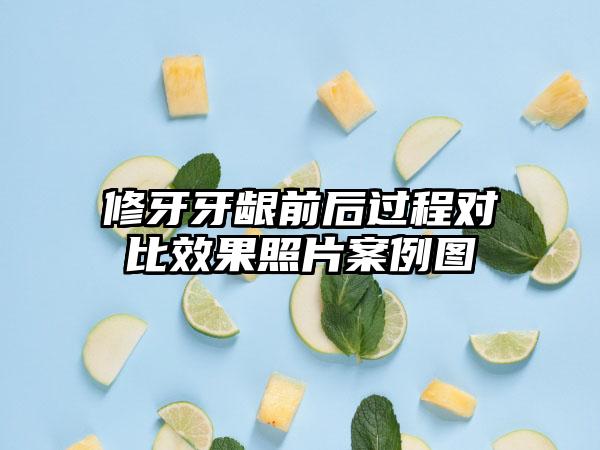 修牙牙龈前后过程对比效果照片案例图