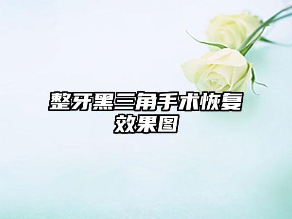 整牙黑三角手术恢复效果图