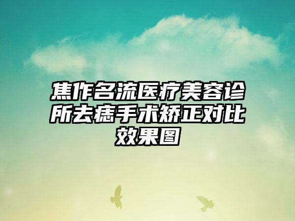 焦作名流医疗美容诊所去痣手术矫正对比效果图